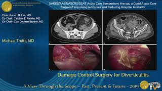 Damage Control Surgery for Diverticulitis [upl. by Haisej]