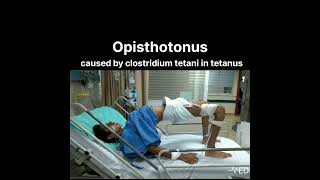 Opisthotonus caused by clostridium tetani in tetanusdoctorviral viralvideo ankylosingspondylitis [upl. by Lambrecht]