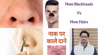 Trichostasis Spinulosa  Nose Blackheads  Nose Hairs  Nose Acne नाक पर काले दाने और बाल nosehair [upl. by Yleik]