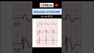 What is Brugada Syndrome [upl. by Stultz]