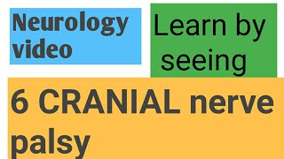 Rt abducens palsy  rt 6 cranial nerve palsy [upl. by Haughay936]