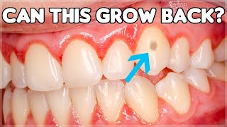 Can Tooth Enamel Grow Back How To Prevent Enamel Erosion [upl. by Nanek]