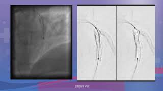 ANGIOPLASTIA COMPLEJA OCLUSION TOTAL DE RAMO DIAGONAL [upl. by Noral108]