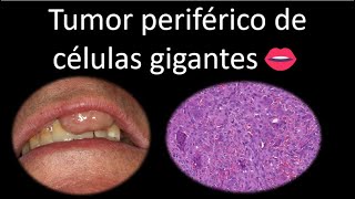 👄 Tumor periférico de células gigantes  Cavidad oral  Cabeza y Cuello  Patología [upl. by Eeladnerb]