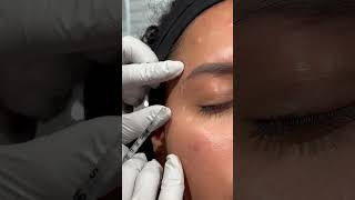 Botox injection crow’s feet amp brow lift botox aesthetics injectables [upl. by Borras]