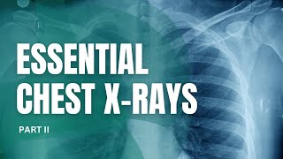 Essential Chest Xrays for Students Part II [upl. by Nohtiek]