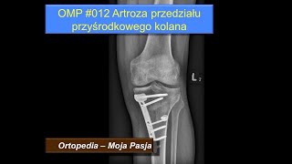 Artroza kolana Zmiany zwyrodnieniowe przedziału przyśrodkowego stawu kolanowego  OMP 012 [upl. by Avruch735]