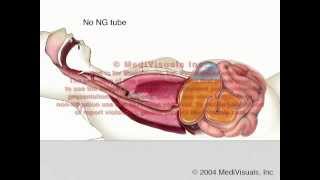 NG Tube vs Aspiration  Fluid Regurgitation [upl. by Aduh]