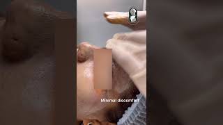 COSMELANstrongest depigmentation peel [upl. by Gerbold]