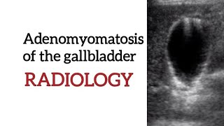 Adenomyomatosis of the gallbladder  Ultrasound features  Radiology [upl. by Gnilyarg742]