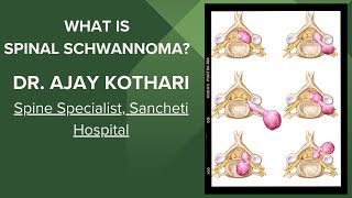 Spine schwannoma neurofibroma nerve sheath tumour  causes treatment Dr Ajay kothari [upl. by Cynara982]