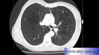 Emphysema on CT scan of Chest [upl. by Oiredised24]