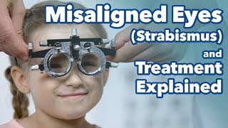 Misaligned Eyes Strabismus and Treatment Explained What is Strabismus [upl. by Somerset]