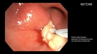 Cryoextraction of large mucous plug using ERBECRYO® 2 with 11mm cryroprobe [upl. by Claudian66]