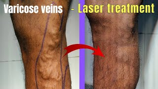 Combination treatment of varicose veins  Laser  Foam Sclerotherapy Laser treatment of varicose [upl. by Henry]