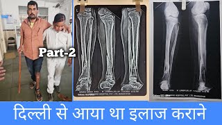 tibia bone fracture recovery without surgery दिल्ली से इलाज कराने आया था मरीज। [upl. by Shuma24]