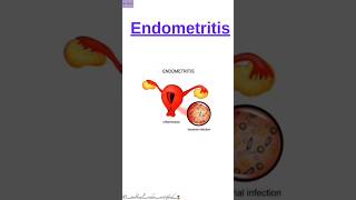 EndometritisShortsCPC Exam ShortsMedical Coding and Billingmedicalcodercertified [upl. by Freeland260]