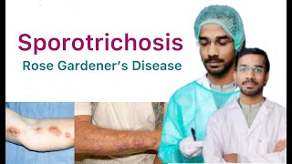 Sporotrichosis  Rose Gardeners Disease  Subcutaneous Mycosis [upl. by Eelirrem442]