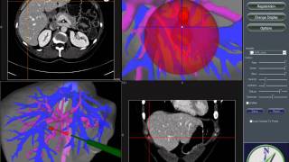 ImageGuided Liver Ablation [upl. by Anthony29]