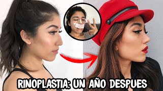 Rinoplastia COSTOS ASIMETRIA INFLAMACION TODA MI EXPERIENCIA [upl. by Gnuh]