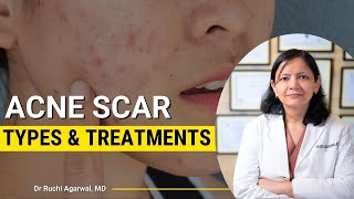 Acne scars treatment  Acne scars before and after  Acne Treatment Skincare  Acne treatment [upl. by Bevers681]