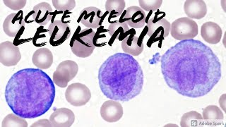 Acute Myeloid Leukemia AML w Monocytic Differentiation formerly AMML with Blasts amp Promonocytes [upl. by Ahsinav]