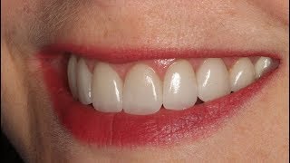 Como Faço uma Prótese Dentária de Silicone Removível Como Faço para Ter uma Prótese Dessa [upl. by Consolata]