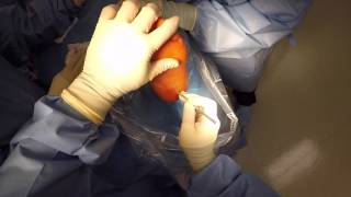 Plantar Fasciotomy [upl. by Petrie]