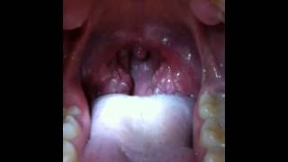 Are these Tonsil Stones [upl. by Scholem973]