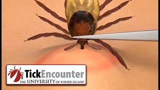 How to Remove a Tick [upl. by Enner]