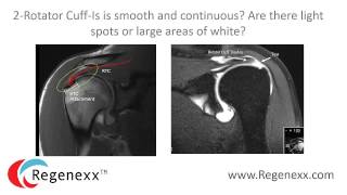 How to read your shoulder MRI with Dr Centeno of Regenexx [upl. by Mahmud]