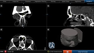 Bilateral revision endoscopic sinus surgery [upl. by Zanas247]