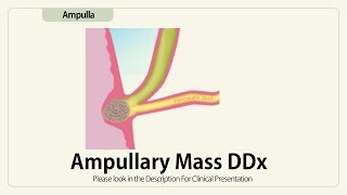 Ampullary Mass DDx [upl. by Snyder801]