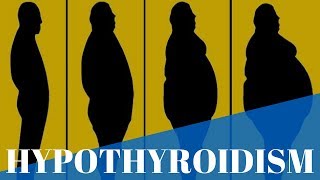 HypothyroidismWhat is it Causes Symptoms and Treatments [upl. by Ainniz]