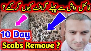 Final Wash  Scabs Remove  Scalps Removed  Hair Transplant side effects  Hair Transplant [upl. by Limaa882]