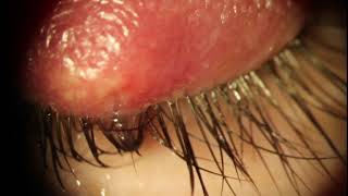 Huge External Hordeolum Stye  Lanced and Milked [upl. by Razaele]