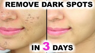 In 3 DAYS  Remove DARK SPOTS BLACK SPOTS amp ACNE SCARS  Anaysa [upl. by Sisely7]