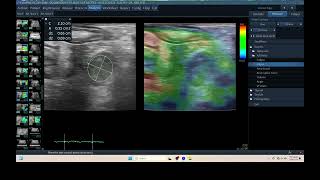 IQ 309 MESENTARY LN ENLARGEMENT ASCITES BLOOD LYMPHOMA ULTRASOUND ELASTOGRAPHY [upl. by Sheelah731]