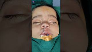 Best Surgeon For Cleft Lip and Nose Repair in India  Dr Parit Ladani [upl. by Vezza]