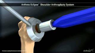 Arthrex Arthrex ECLIPSE™ Shoulder Arthroplasty System [upl. by Yarb]