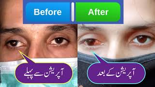 Successful squint 25 Degree Right Eye correction surgery  Urdu Hindi [upl. by Anallise52]