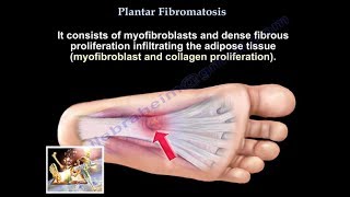 Plantar Fibromatosis  Everything You Need To Know  Dr Nabil Ebraheim [upl. by Sammy]