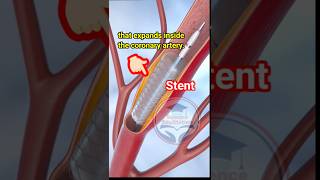 Angioplasty🫀❤️‍🔥 Coronary artery Stent Insertion science medical angioplasty shorts viral [upl. by Acnaib467]