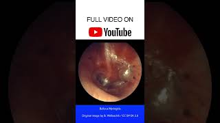 Bullous Myringitis Otoscopy [upl. by Tews]