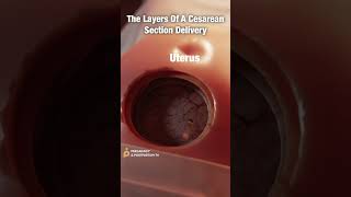 Layers of CSection Delivery ✨FASCINATING✨ shorts [upl. by Delores]