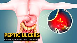 Peptic Ulcers Causes Signs and Symptoms Diagnosis and Treatment [upl. by Euqilegna506]