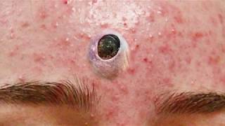 Big Blackheads Cyst and Forehead Pimples [upl. by Rolyat]