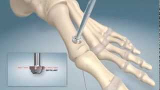 1st MTPJ arthrodesis procedure [upl. by Starla572]