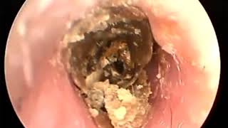 Earwax Removal Extractions Very very hard 外耳道挖耳屎清理，硬菜 耳垢 耳垢 [upl. by Daberath]