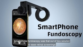 Smartphone Fundoscope Fundus Explorer PRO [upl. by Maggio7]